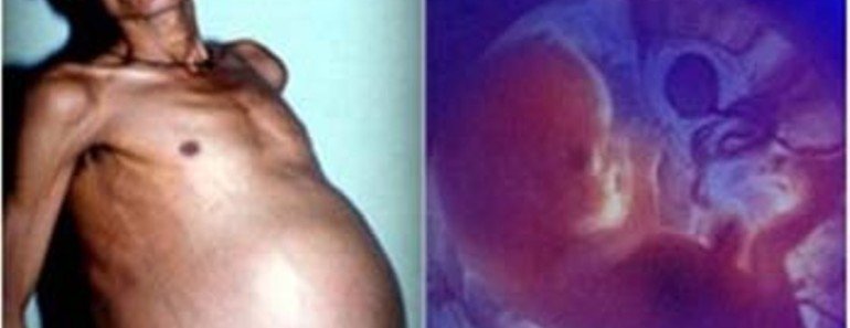 Sanju Bhagat: The Man Who Lived With His Parasitic Twin for 36 Years